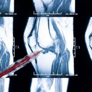 MRI of Meniscus Tear