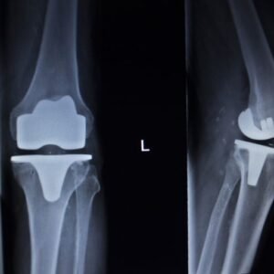 Xray of Meniscus Implants